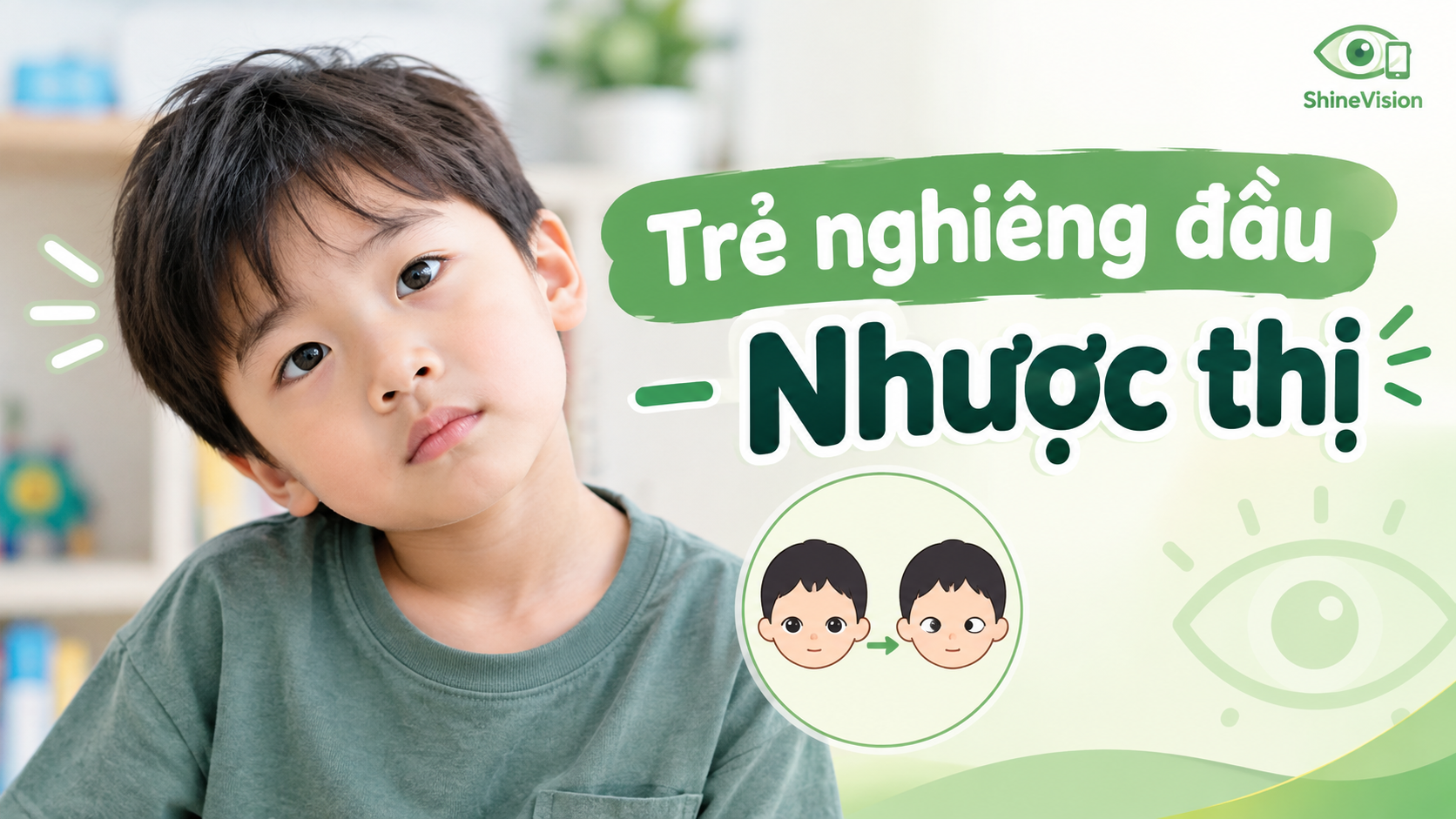 Trẻ nhìn nghiêng đầu dấu hiệu và nguy cơ gây nhược thị